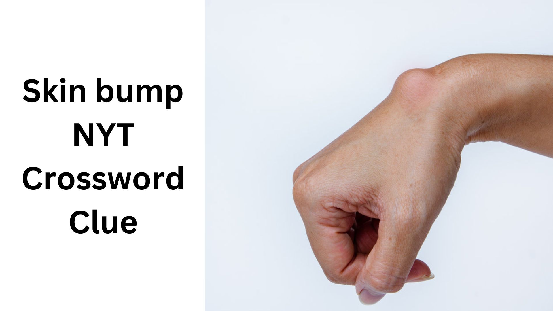 Skin bump NYT Crossword Clue