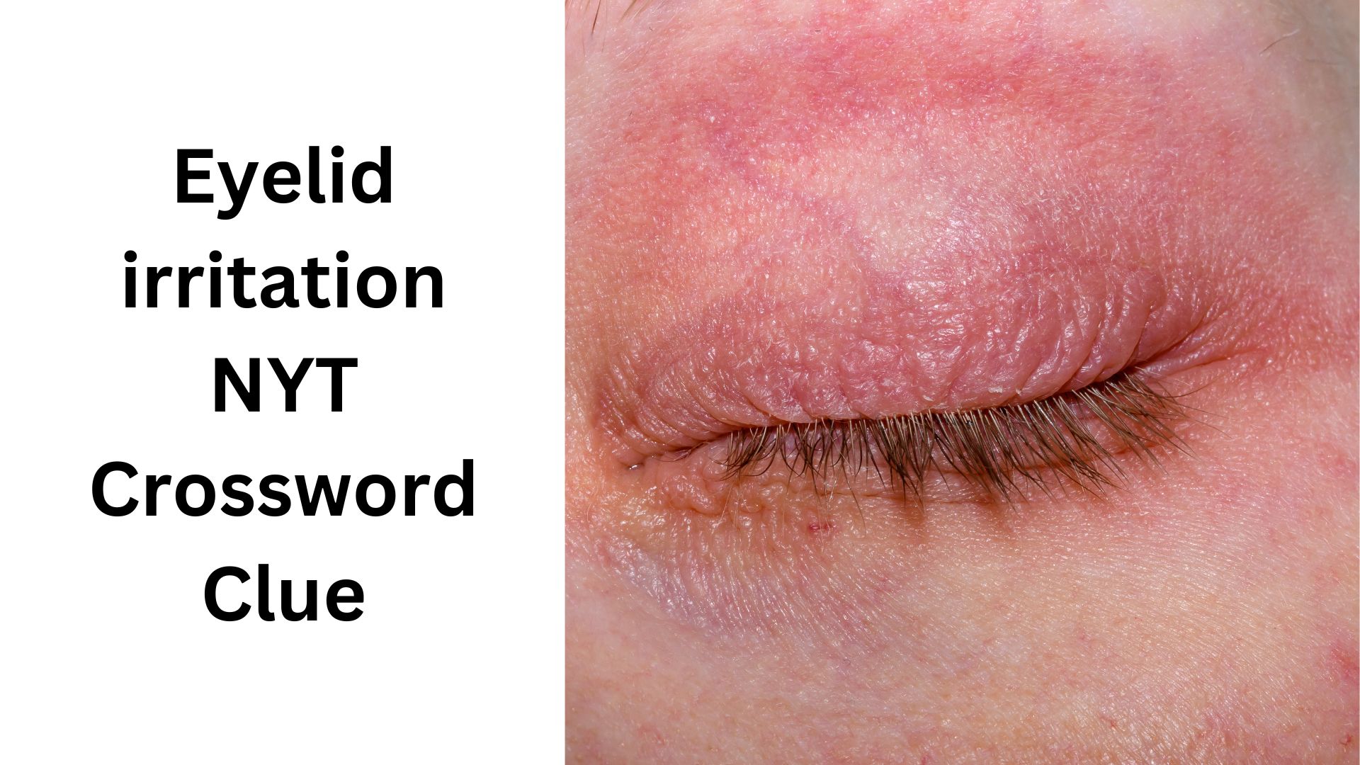 Eyelid irritation NYT Crossword Clue